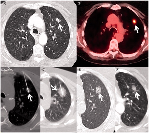 Figure 1. An 80-year-old woman with cardiovascular disease (previous coronary artery bypass graft surgery) and severe emphysema from 40 packs per year smoking history developed an early stage non-small cell lung cancer and was referred for tumour ablation due to her high operative risk. (A) Axial CT image in lung windows shows the 1.4 cm left upper lobe NSCLC (arrow). (B) Axial fluorodeoxyglucose PET/CT fusion image shows intense standard uptake value (SUV) of 6.8 (arrow) without evidence of regional or distant spread (Stage IA). (C) Axial image during the microwave ablation shows satisfactory placement of the antenna within the centre of the mass parallel to the long axis (arrow) and (D) after 10 min of heating with 65 W a circumferential ’ground glass halo’ appears indicative of thermal damage to the mass and adjacent normal lung; (E) 1-month and (F) 6-month follow-up CT scans show the baseline thermal scar with antenna tract still visible (arrow) and expected involutional changes at 6 months.
