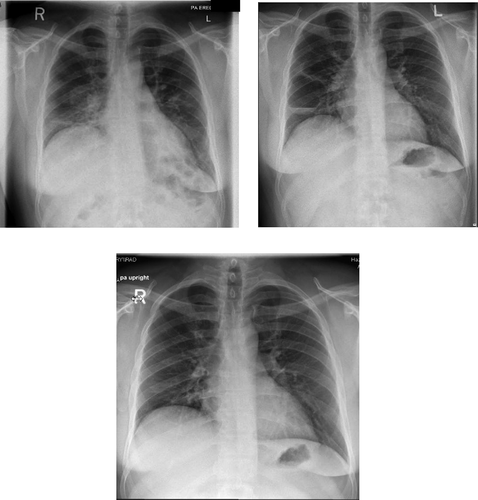 Figure 1. (a) Chest radiograph: multiple bilateral mid and lower zone airspace opacities. (b) Chest radiograph: pneumatocele with air fluid level in right lower lobe. (c) Follow up chest radiograph: resolution of pneumatocele in the follow up CXR.