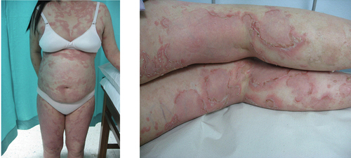 Figure 3. A 29-year-old woman with a clinical form of annular GPP and large imprecise areas of sterile pustules with erythema. The patient had a history of psoriasis on the scalp and limbs and recurrent GPP flares. (images reproduced from Choon et al. Experimental dermatology 2023;32:1284–1295. Published under CCBY license https://creativecommons.org/licenses/by/4.0/).