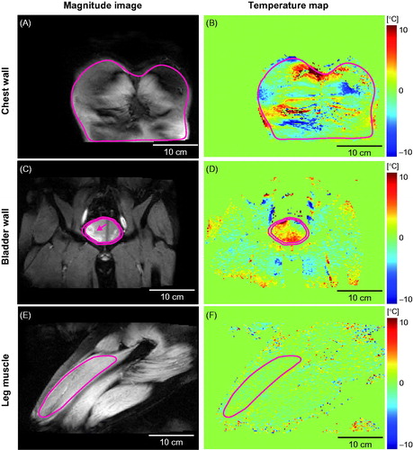 Figure 2. Representative MR temperature maps (coronal plane) of the chest wall, bladder wall, and leg muscle shown next to the corresponding magnitude images. The solid lines indicate the perimeter of the region of interest (ROI). In Figure 2 C, the voxels with high-signal intensity observed on the left side the bladder (indicated by an arrow) showcase urine filling to the bladder.