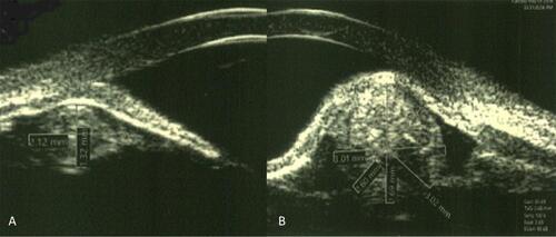 Figure 2 In UBM imaging of the left eye, Ovoid hyperechoic structures cause iris bombe in supra- temporal (A) and inferonasal (B) quadrants. Significant closure of anterior chamber angle is visible in both pictures.