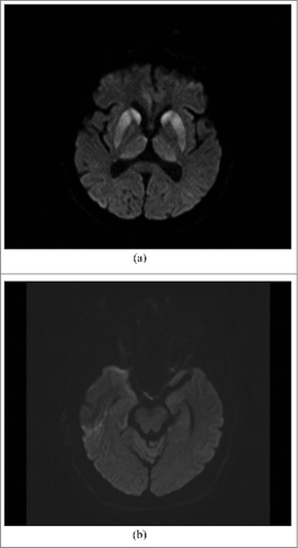 Figure 1. (A). MRI DWI: abnormal high signal intensity in both caudate nuclei, putamina and thalami, particularly prominent in heads of caudate nuclei and anterior parts of putamina. (B). MRI DWI: slight changes in cortex of right temporal lobe and colliculi inferior.