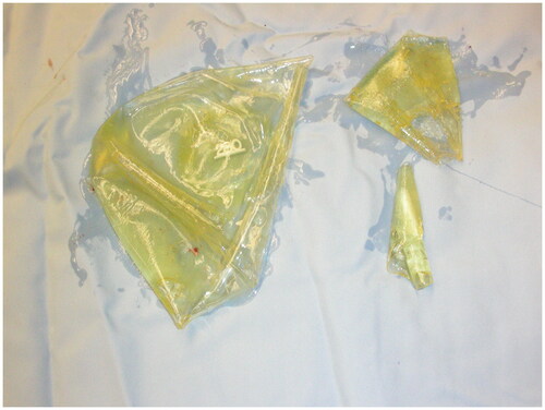 Figure 2. Fragments of left 280 cc breast implant that extruded from the right breast implant space upon entry.