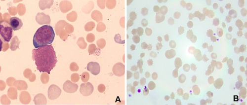 Figure 1 (A) Bone marrow smear showed that erythroid hyperplasia is obviously active, megakaryocytes are reduced, and the production of platelet is poor (magnification: 1000×). (B) The peripheral blood smear showed broken red blood cells (magnification: 100×).