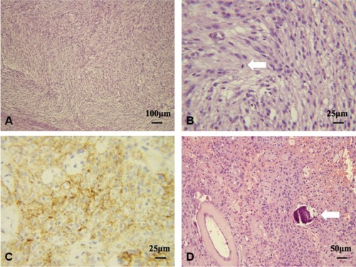 Figure 4 A–D Histologic findings of atypical meningiomas (World Health Organization) grade II.