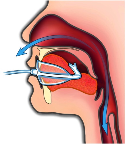 Figure 2 © ApniCure, Inc. With the mouthpiece in place, gentle oral vacuum creates a pressure gradient intended to move the soft palate against the tongue to relieve airway obstruction during sleep.