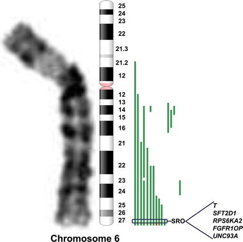Figure 1. Schematic representation of chromosome arm 6q rearrangement. Distribution of breakpoints of chromosome 6q in 15 HR-NB samples. Green lines on the right side of the ideogram represent losses; the red line represents gain. The indicated five genes in the 6q27 region meet the following criteria: statistically significantly lower expression of the gene in NB cell lines with vs without 6q loss, at least one mutation in the gene as described in primary NB, and statistically significantly worse survival outcome when gene expression is low in HR-NB. SRO = smallest region of overlap.
