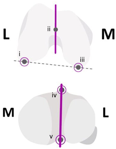 Figure 2. The Top image depicts the landmarks on the femur: (i) lateral condyle, (ii) femur center, (iii) medial condyle, solid line is the AP axis (whiteside’s line), dashed is the posterior condylar axis. The image below depicts the tibial landmarks: (iv) medial third of the tibial tuberosity (MTT) and (v) the PCL insertion point, solid line is the AP axis.