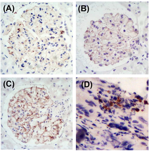 Figure 4. Representative images of glomerular and tumor staining for THSD7A. (A) Patient no. 13 with positive glomerular THSD7A staining. (B) Patient no. 14 with positive glomerular THSD7A staining. (C) Patient no. 15 with positive glomerular THSD7A staining. (D) Patient no. 14 with positive THSD7A staining of small cell lung cancer tissue (immunohistochemistry staining, magnification ×400).