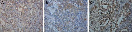 Figure 1 Immunohistochemical analysis showed positive staining: (A) MET, (B) GLUT1, and (C) PKM2 (magnification ×400). Scale bar: 50 μm.