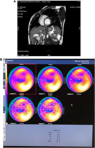 Figure 1 Cardiac magnetic resonance and cardiac PET imaging (same patient). (A) In short axis view, no cardiac involvement on LGE images. (B) Increased 18F-FDG-PET uptake on lateral and inferolateral walls of left ventricle on bulls eye map and on slices (indicating jeopardized area).