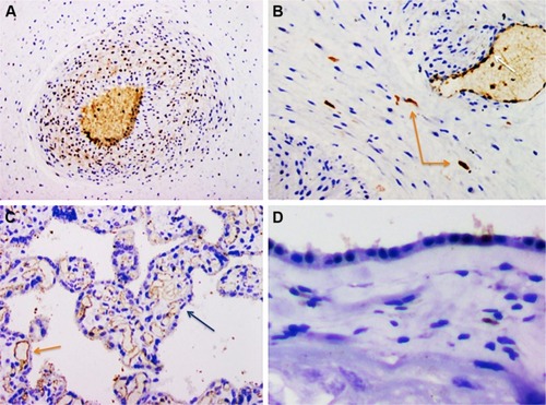 Figure 1 VEGF-A. Representative immunohistochemistry staining for VEGF-A in the placental disc. Positive expression demonstrated for smooth muscle of chorionic vessels, 10× (A), stromal chorionic cells, 20× (orange arrows), with positive internal control in chorionic endothelium (white arrow), and villous endothelial positivity (B), 20× (orange arrow), with negative internal control in syncytiotrophoblast (blue arrow) (C). Amnion negativity is shown 20× (D).