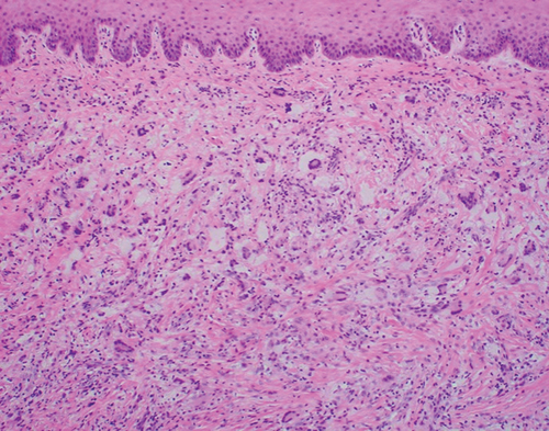 Figure 2. Photomicrograph demonstrating foamy histiocytes and scattered Touton giant cells in the lamina propria (hematoxylin & eosin [H&E] x 200).