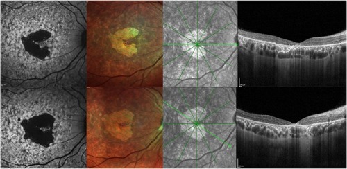 Figure 3 Progression of STGD1. First row: Short wavelength autofluorescence, Multicolor imaging, and OCT at baseline. Second row: Short wavelength autofluorescence, Multicolor imaging, and OCT after 12 months, showing enlargement of the area of RPE and photoreceptor loss on autofluorescence and central retinal thinning the foveal area.