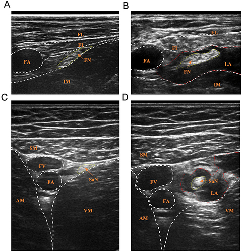 Figure 1 (A) Ultrasound image of FNB. (B) The LA was injected around the FNB. (C) Ultrasound image of ACB. (D) The LA was injected around the SaN.