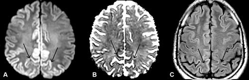 Figure 2 MRI brain on second admission one month later. (A) (DWI) (B) (ADC) and (C) (FLAIR): Bilateral symmetrical parietal cortical FLAIR hyperintense signals with restricted diffusion (open arrows) more marked in the parafalcine regions (closed arrow).