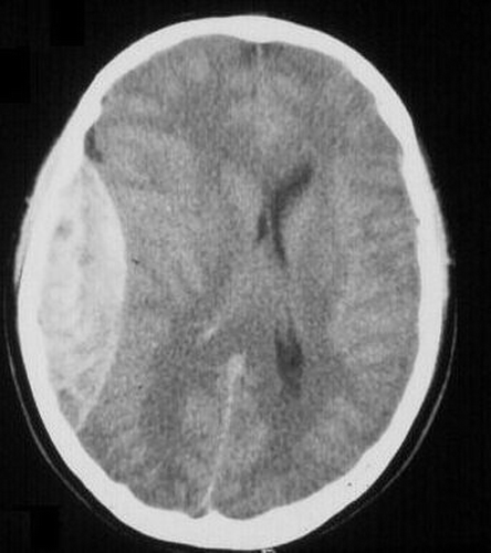 Figure 1. Patient's CT scan with left parietal epidural hematoma. Note the midline shift; the imaging is otherwise normal.