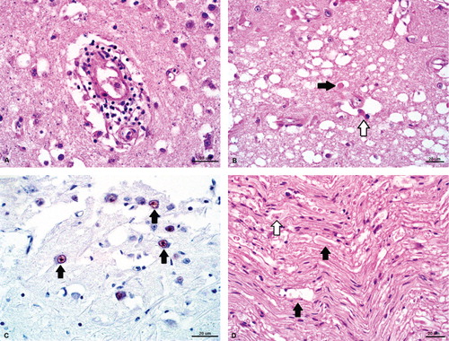 Figure 1. Histologic changes in brain and sciatic nerve of a Himalayan monal (Lophophorus impejanus) from which avian bornavirus genotype 4 was identified. (a) Brain, numerous lymphocytes and plasma cells expanding Virchow-Robin space (H&E stain). (b) Brain, marked neuropil vacuolation, gemistocytic astrocytes (white arrow) and swollen axons (black arrow; H&E stain). (c) Brain, positive immunohistochemical staining for ABV antigen in neuronal nuclei (black arrows) using rabbit polyclonal antiserum raised against ABV nucleocapsid protein. (d) Sciatic nerve, multifocal dilated myelin sheaths (black arrows) and myelin macrophage (white arrow; H&E stain)