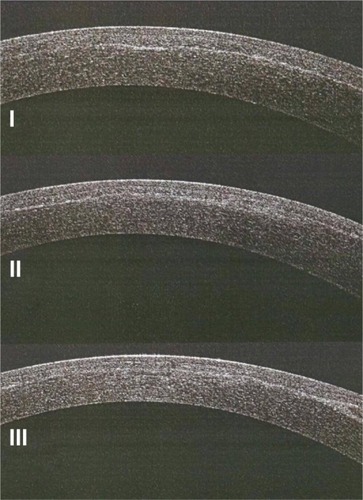 Figure 1 Postoperative anterior segment optical coherence tomography of the cornea of a group A patient shows a rough lamellar cut (I), an irregular interface (II), and the creation of two different dissection planes (III).
