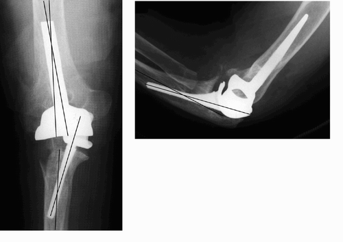 Figure 3. Postoperative lateral and AP radiograph (case 25; Table). The humeral component is positioned in varus; the ulnar component is positioned in varus and flexion. The malalignment relative to the axis of the bone is illustrated. Also, note the subluxation with valgus tilt of the prosthesis.