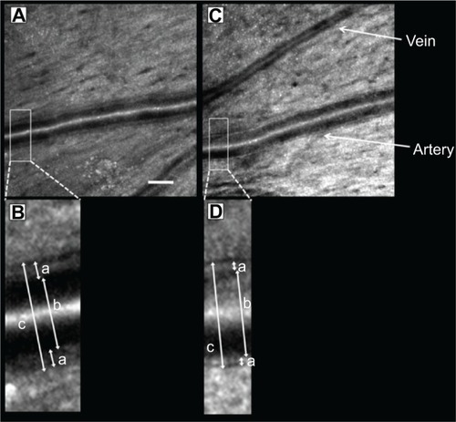 Figure 2 Adaptive optics scanning laser ophthalmoscopy (AO-SLO) images of thickened retinal arterial wall.