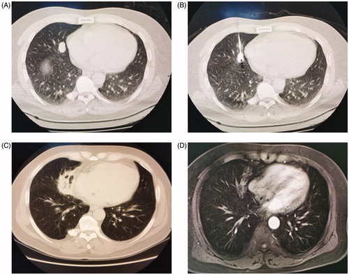 Figure 1. (A) Chest CT image before ablation therapy shows a tumor with the maximum diameter of 15 mm. (B) CT image during MWA shows the antenna inserted into the tumor. (C) Follow-up CT scan after 1 month shows air inside the tumor and is evaluated as complete ablation. (D) Contrast enhanced MRI scan after 2 month shows marked involution of the tumor without contrast enhancement.