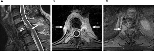 Figure 1 Three typical morphological features implying malignancy on MRI. (A) Convex posterior cortex (arrow indicated) on sagittal view; (B) epidural mass formation (arrow indicated) on axial view; and (C) pedicle enhancement (arrow indicated) on Gd-DTPA enhanced axial view.Abbreviations: Gd-DTPA, a gadolinium-based MRI contrast agent; MRI, magnetic resonance imaging.