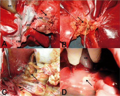Figure 1. (A) Image showing the hepatic anatomy of dogs and the proximity of the target hepatic duct to the necrotic area induced by RFA treatment. (B, C) Complete necrosis of the bile duct wall was observed with the development of abdominal adhesions and bile peritonitis when the liver was removed 24 h after RFA. (D) Abdominal infection and inflammatory exudates were observed when liver removal was performed 2 weeks after RFA. GB, gallbladder; CBD, common bile duct; LBD, left bile duct; LHD, left hepatic duct.