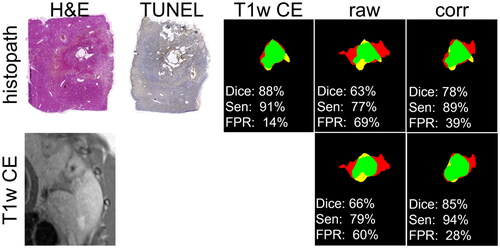 Figure 4. Comparison of the predicted ablation zone assessed by T1w-CE, uncorrected (raw) and susceptibility corrected (corr) thermometry with histopathology (first row) and T1w-CE as reference (green area: intersection, yellow area: false negative, red area: false positive). Dice coefficients (Dice), sensitivities (Sen) and False Positive Rate (FPR) are given related to histopathology (first column) and T1w-CE (second column). Correspondingly, H&E and TUNEL staining as well as the image of T1w-CE are shown.