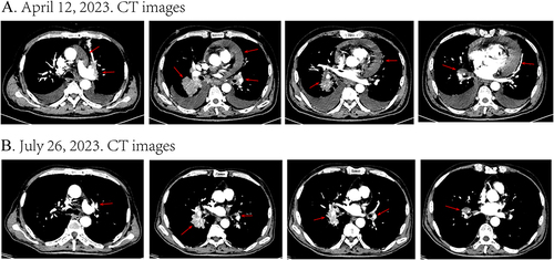 Figure 1 Disease status after three months of targeted therapy. (A) Pre-treatment CT images showed a substantial presence of pericardial and pleural effusion, accompanied by a right lung mass (Use 3 red arrows for indication). Furthermore, multiple hilar and mediastinal lymphadenopathies were observed. (B) After three months of targeted therapy, the patient demonstrated complete resolution of pericardial and pleural effusion, and a significant reduction in the size of the right lung mass, hilar and mediastinal lymph nodes. The tumor response evaluation indicated a partial response (PR).