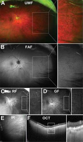 Figure 8. 73 year old Caucasian female with reticular pigmentary degeneration. (A) UWF imaging demonstrates reticular pigmentary degeneration in the nasal far periphery and magnification of this area demonstrates the typical “honeycomb” appearance. (B) On FAF, these structures can appear predominantly hypofluorescent. (C) Red-free and (D) green-free images highlight reticular pigmentary degeneration as light and dark areas respectively pointing to RPE involvement. (E) Infra-red imaging shows hyperreflective lesions corresponding to reticular pigmentary degeneration (F) OCT imaging highlights RPE involvement and outer retinal disruption of reticular pigmentary degeneration. Abbreviations as in Figure 3.