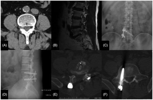Figure 3. A typical case of MIS-TLIF BPS. Notes: (A) coronal CT shows L5/S1 right FLDH. (B) sagittal MRI shows L5/S1 FLDH. (C) and (D) X-ray images demonstrate permanent position after 1 year.(E)coronal and（F）sagittal CT images after 1 year.