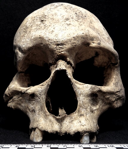 fig 10 Butler’s Field 65. Well-healed trauma to the right side of the viscerocranium of BF-65 resulting in asymmetrical eye orbits and possible soft tissue abnormalities that would have been noticeable in many social interactions. Scale in centimetres. Photograph by S Bohling with permission of the Corinium Museum.