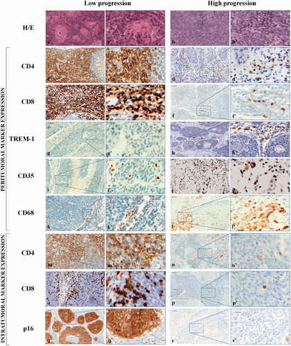 Figure 1. Representative haematoxylin and eosin (H-E) staining and expression of peritumoral and intratumoral markers in low and high progression OP-SCCs. Top panel: H-E staining. 20× (a, b) and 40× (a’, b’). Middle panel: peritumoral infiltration expression. CD4: 20× (c, d) and 40× (c’, d’); CD8: 20× (e, f) and 40× (e’, f’); TREM-1: 20× (g, h) and 40× (g’, h’); CD35: 20× (i, j) and 40× (i’, j’); CD68: 20× (k, l) and 40× (k’, l’). Bottom panel: intratumoral markers expression. CD4: 20× (m, n) and 40× (m’, n’); CD8: 20× (o, p) and 40× (o’, p’); p16: 20× (q, r) and 40× (q’, r’). The black boxes in the 20× fields correspond to the 40× magnification fields. Markers have been developed with 3,3’-diaminobenzidine. Scale bar: in the 20× fields,50 µm; in the 40× fields, 20 µm.