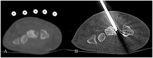 Figure 2. Computed tomography axial scans of a patient with symptomatic intra-articular osteoid osteoma in the hand (biopsy proven). (A) Radio-opaque mesh is placed over the skin for entry point selection. (B) Post biopsy, the radiofrequency electrode is coaxially inserted and ablation session is performed with osteoid osteoma protocol according the manufacturer’s guidelines.