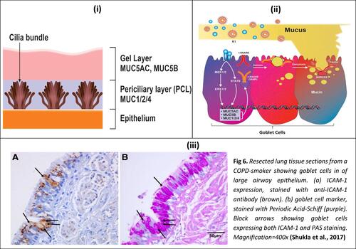 Figure 1 Schematic illustration of a goblet cell, associated signalling for mucous secretion and microscopic images of goblet cells: (i) The gel on brush model describes mucus existing in two discrete layers, a more viscous gel layer on top and a periciliary layer (PCL) below. The gel layer contains the secreted mucins MUC5AC and MUC5B whilst the PCL contains the membrane-tethered mucins MUC1, MUC2 & MUC4; (ii) Viral infection induced signalling involved in mucus secretion; (iii) Lung tissue sections from a COPD-smoker showing goblet cells of large airway epithelium.Notes: Figure 1 (iii) reproduced with permission from Shukla SD, Mahmood MQ, Weston S, et al. The main rhinovirus respiratory tract adhesion site (ICAM-1) is upregulated in smokers and patients with chronic airflow limitation (CAL). Respir Res. 2017;18(1):6.Citation14