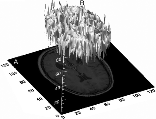 Figure 1.  Three-dimensional textured intensity surface representation of a medical image. A: MR image through the brain. B: Pixel values of image plotted on the vertical axis.