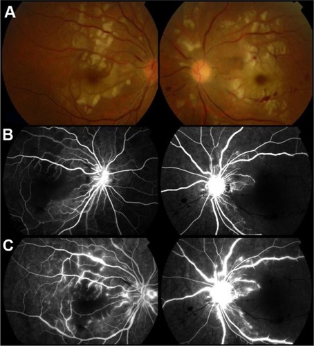 Figure 2 (A) After pulse therapy, there were increasing cotton-wool spots and multiple arterioles narrowing at the macula in her right eye and confluent macular cotton-wool spots presenting like cherry-red spots with attenuated smaller arterioles in her left eye. (B) At the early phase in the macula, a small branch of a capillary nonperfusion zone was observed in the right eye, and multiple branches of arterioles were occluded in the left eye. (C) At the late phase in the macula, perivascular leakage of multiple arterioles was observed in both eyes. There was an extensive capillary nonperfusion zone in the left macula.
