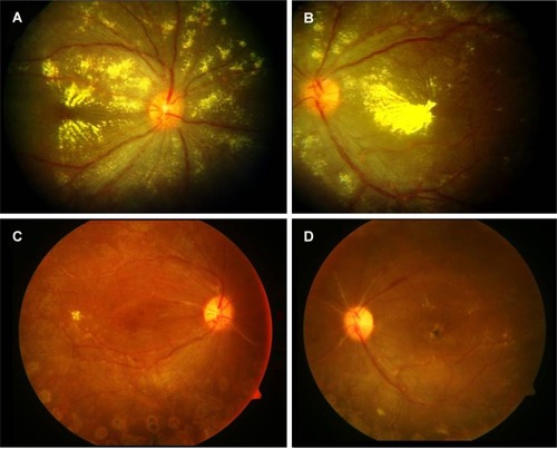 Figure 4 Fundus photography of both eyes of an 11-year-old girl who presented with blurring of vision both eyes.