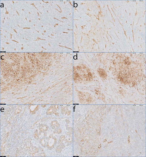 Figure 4. HLA-I expression patterns in biphasic and poorly differentiated SS.Antibody staining specific for HLA-A and HLA-B/C on tumour sections of biphasic SS (a-e) and poorly differentiated SS (f). a) Absent staining of HLA-A on SS46. b) Low, focal expression of HLA-A on SS15. c-e) Heterogeneous expression of HLA-A on SS34 (c) and HLA-B/C on SS23 (d) and SS24 (e) with the biphasic component of the tumour demonstrating clear up regulation of HLA-I compared to the spindle cell compartment that lies in between the biphasic parts. Note that HLA-I is elevated on the epithelial-like ducts in SS24 (e). f) SS50, demonstrating heterogeneous expression of HLA-A on a poorly differentiated SS.Scale bars a-c, e-f: 50 µm; d: 100 µm.