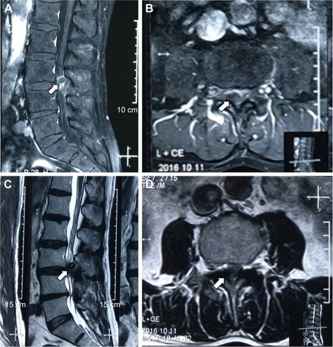 Figure 4 Lumbar spine magnetic resonance imaging (MRI) images demonstrating an abnormal round epidural collection at the L3/4 level, compromising the spinal canal and causing cauda equina compression (indicated by the arrows).