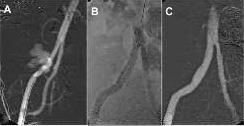Figure 2 External iliac artery rupture treatment.