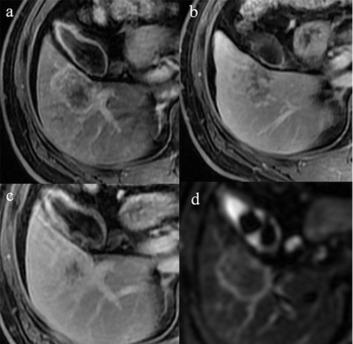 Figure 4 Intrahepatic cholangiocarcinoma in two patients, a 48-year-old man with chronic hepatitis B. On the axial arterial phase image (a), the liver mass on segment 5 showed thin-rim arterial phase hyperenhancement (APHE). On portal venous phase and delayed phase images (b and c) after administration of extracellular contrast agent, the tumor showed delayed central enhancement. On b-800 DWI image (d), the mass showed a targetoid appearance. The tumor was initially categorized as LR-M by observers. The tumor was re-categorized as modified LR-M according to modified LI-RADS.