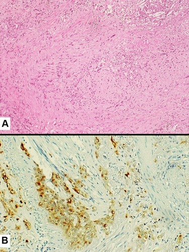 Figure 7 Tumor cell infiltration of a medium-sized vessel wall by spindle cell carcinoma (A) also highlighted by the expression of pan-cytokeratins (clone CAM5.2) (B).