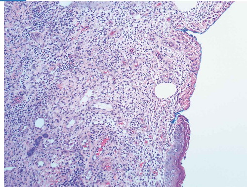 Picture 5. Ulceration of breast with granulation tissue and acute and chronic inflammation