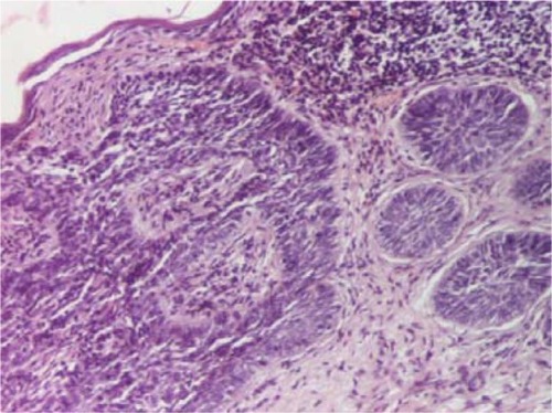 Figure 8 Basal cell carcinoma: typical nuclear palisading at the peripheral layer of the tumor (hematoxylin and eosin, 100×).