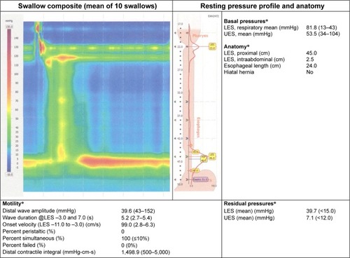 Figure 4 HRTM in a 70-year-old male with spastic type III achalasia, who underwent a successful POEM.