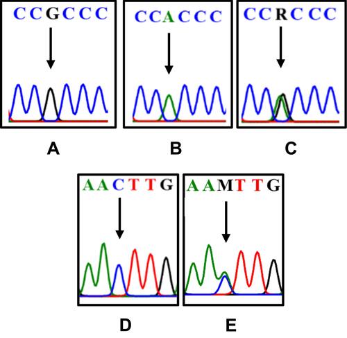 Figure 3 The differences in the DNA sequence of COL1A1 and COL11A1. The arrows indicate G (A); A (B); double peak c.20980A/G=R (C); C (D); double peak c.134373C/A=M (E).