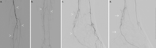 Figure 6 Right lower extremity angiography in a patient with diabetes. A sequential catheter-directed contrast injection depicting the pattern of PAD with exaggerated involvement of below-knee vessels in terms of tortuosity, multi-segmental narrowing, and chronification of collaterals (a–c) (arrowheads). (d) Post-angioplasty posterior tibial artery using a 2-mm non-compliant balloon with resultant improved flow, resolved narrowing, and instant reduction of collaterals (arrow).