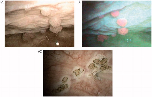 Figure 1. Bladder tumor stage Ta, low grade, illuminated with (A) white light and (B) blue light (photodynamic diagnosis) by flexible cystoscopy before laser destruction of bladder tumor (LDB). (C) Mucosal lesions after LDB; the laser fiber can be seen on the right side of the picture.